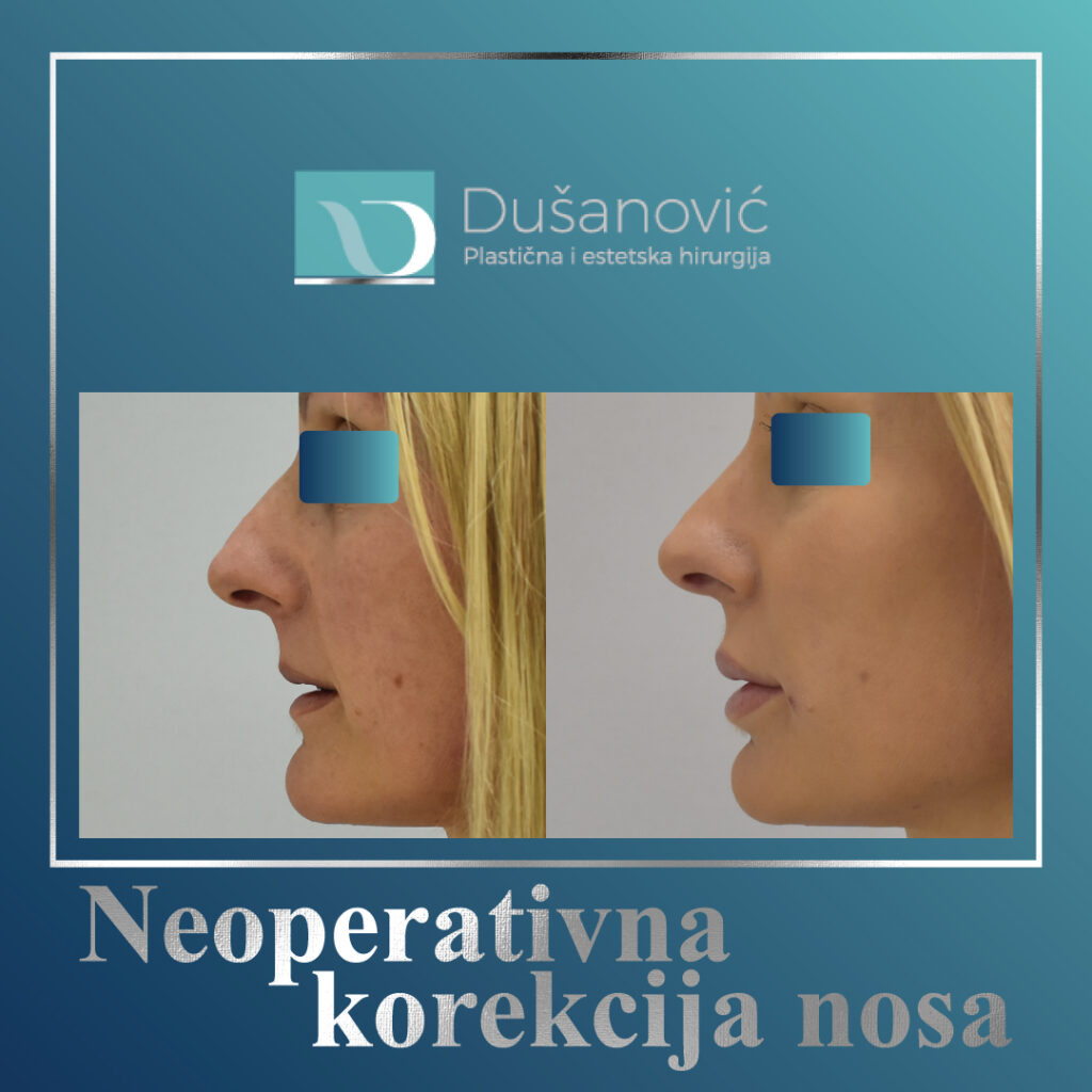 neoperativna korekcija nosa