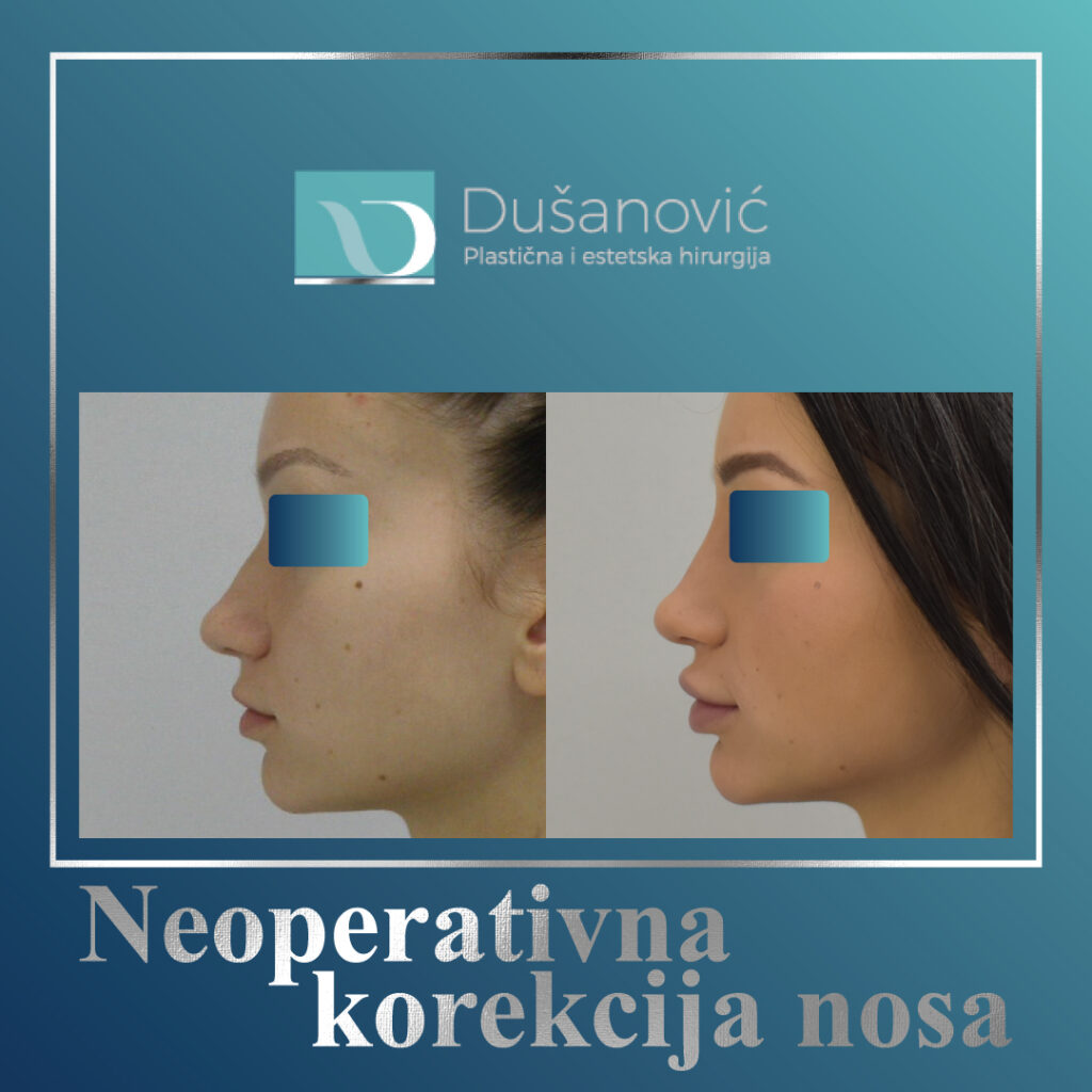 neoperativna korekcija nosa