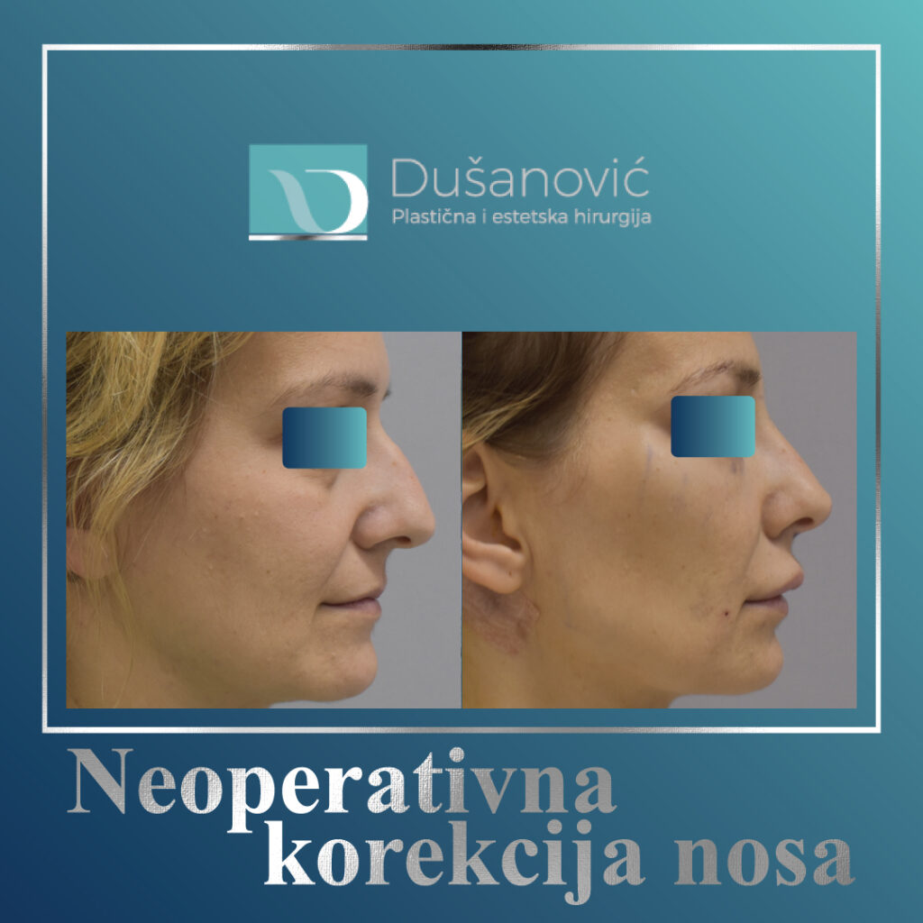neoperativna korekcija nosa