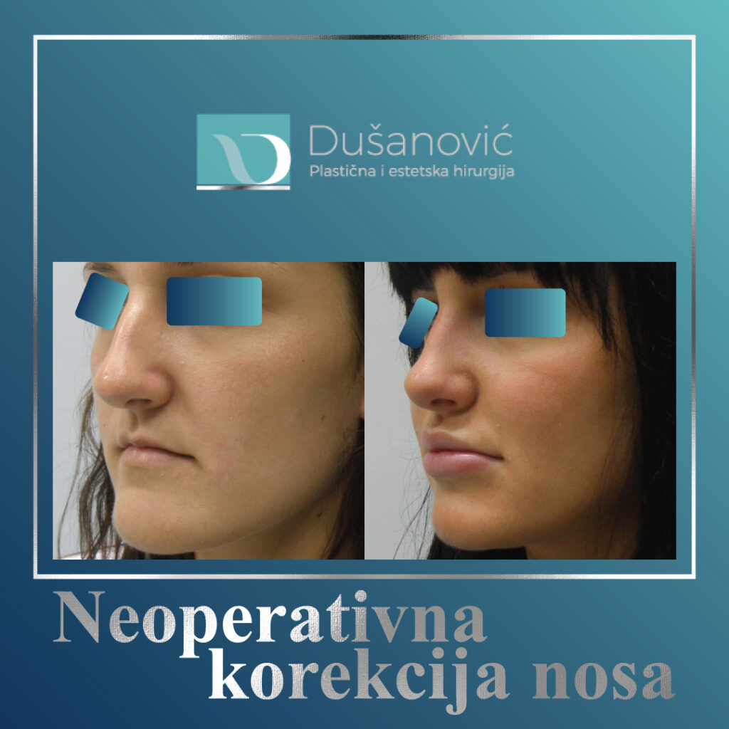 neoperativna korekcija nosa