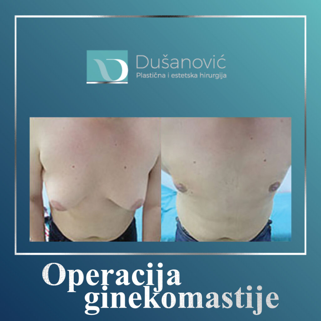 operacija ginekomastije