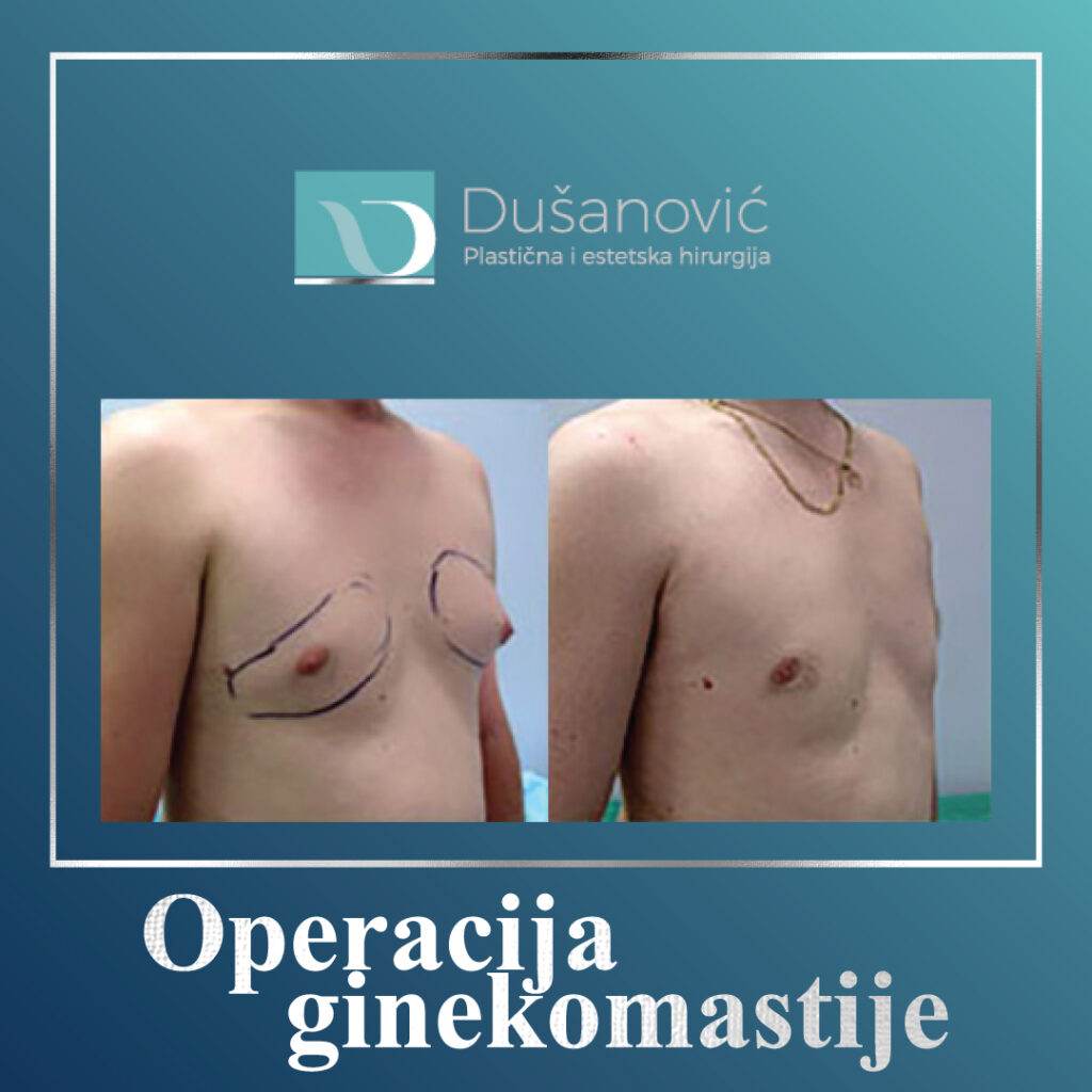 operacija ginekomastije