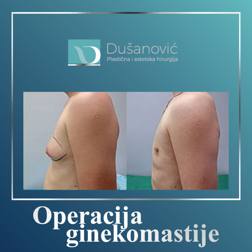 operacija ginekomastije
