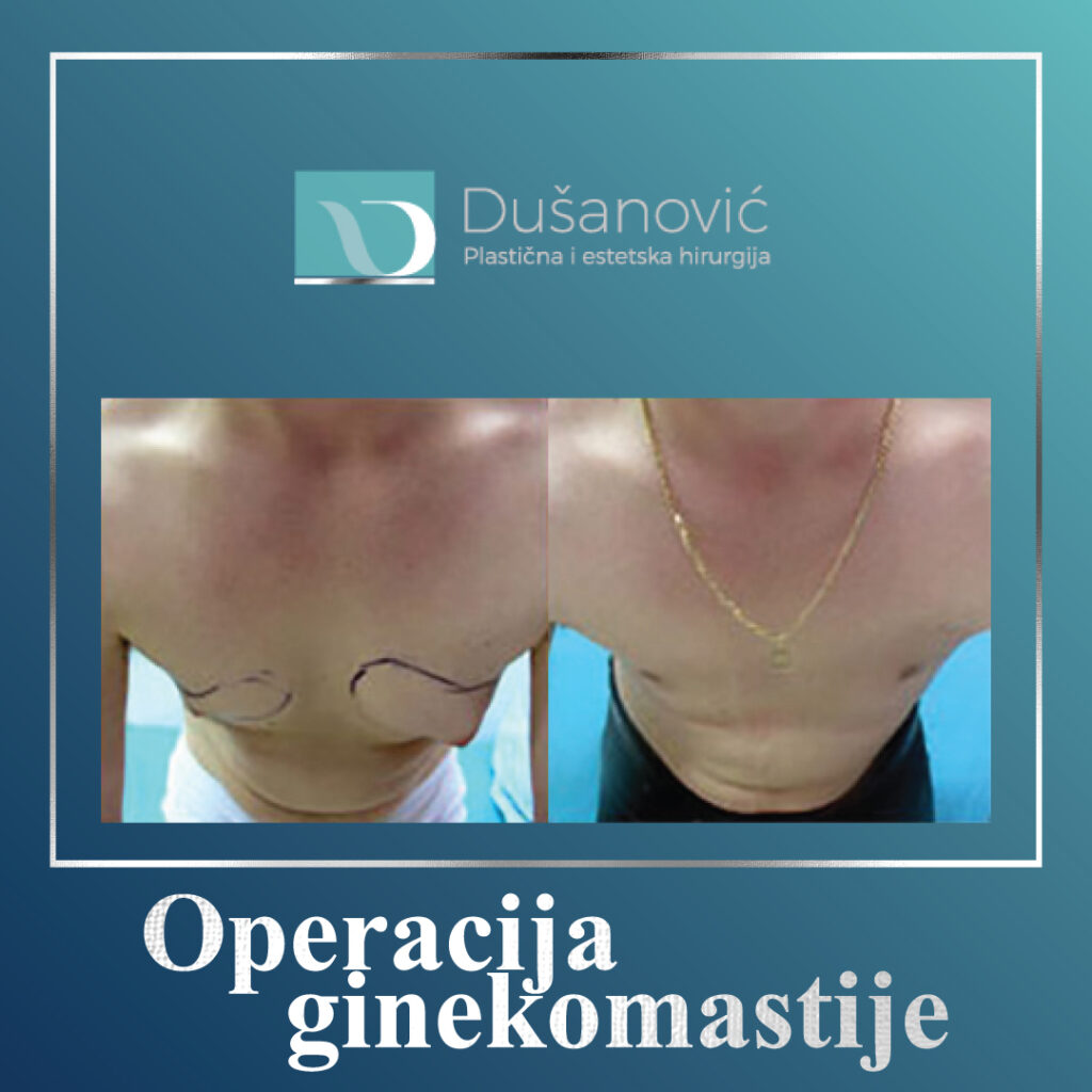 operacija ginekomastije