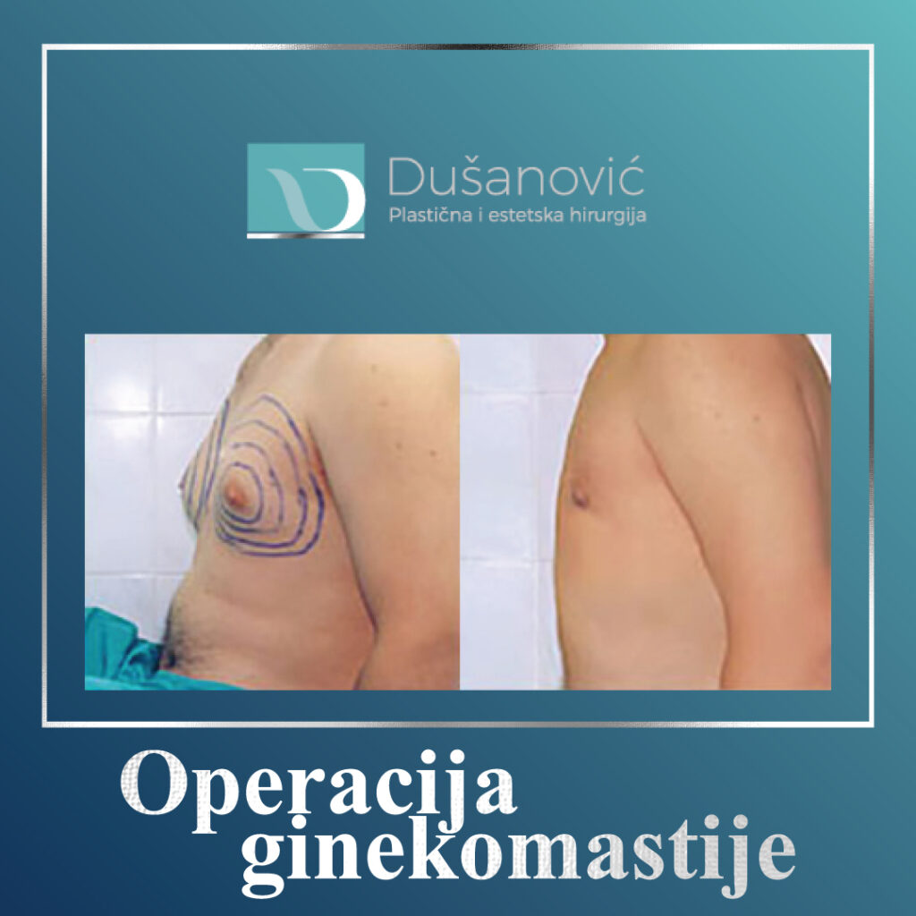 operacija ginekomastije
