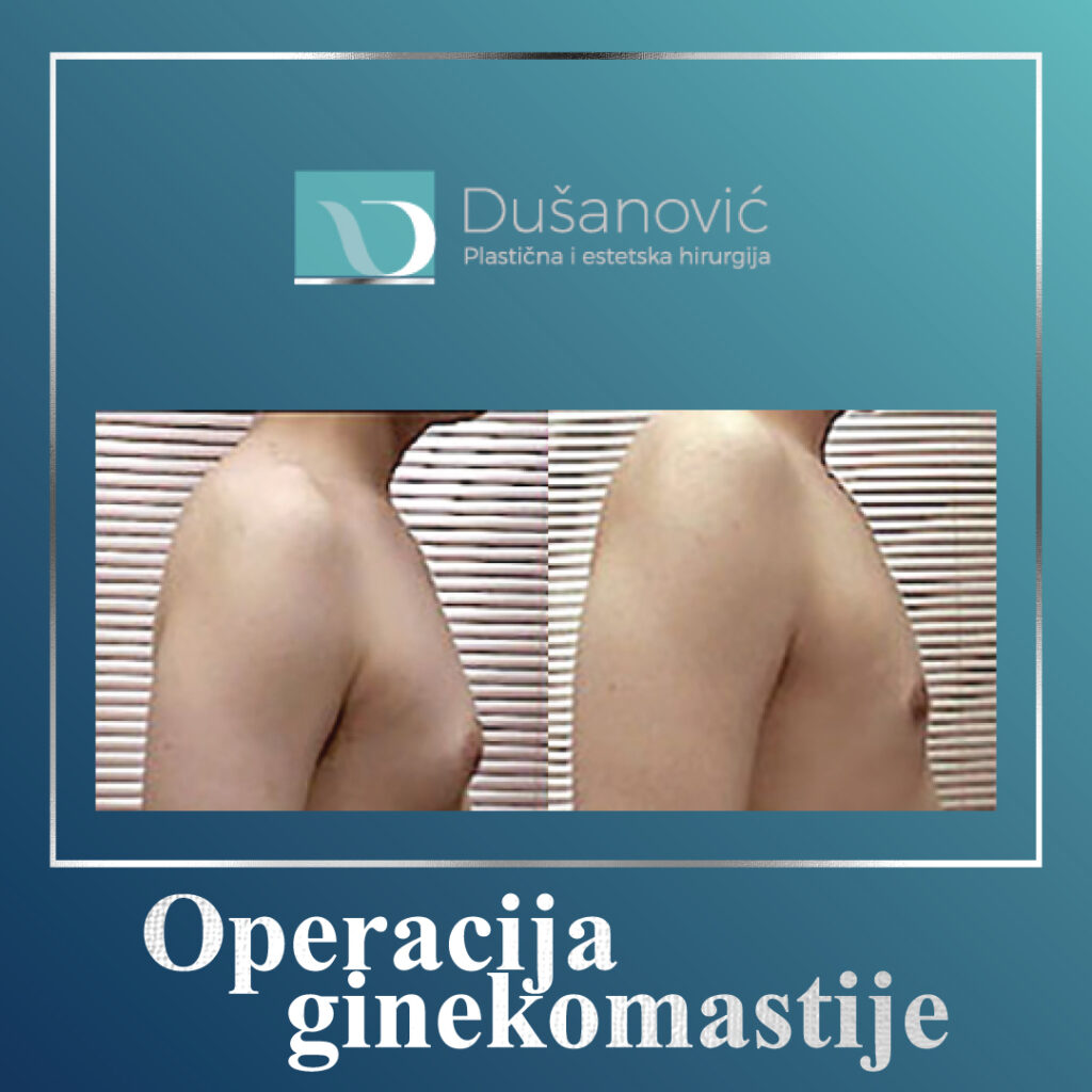 operacija ginekomastije
