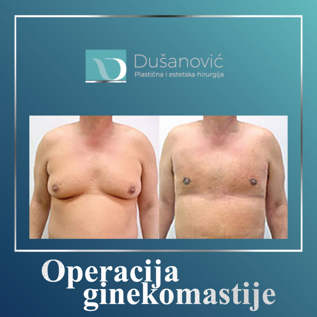 operacija ginekomastije