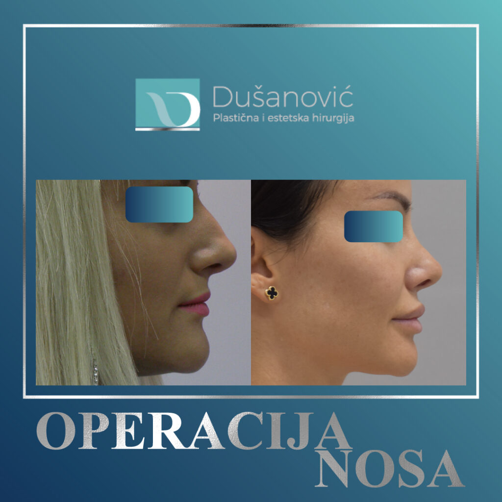 korekcija nosa