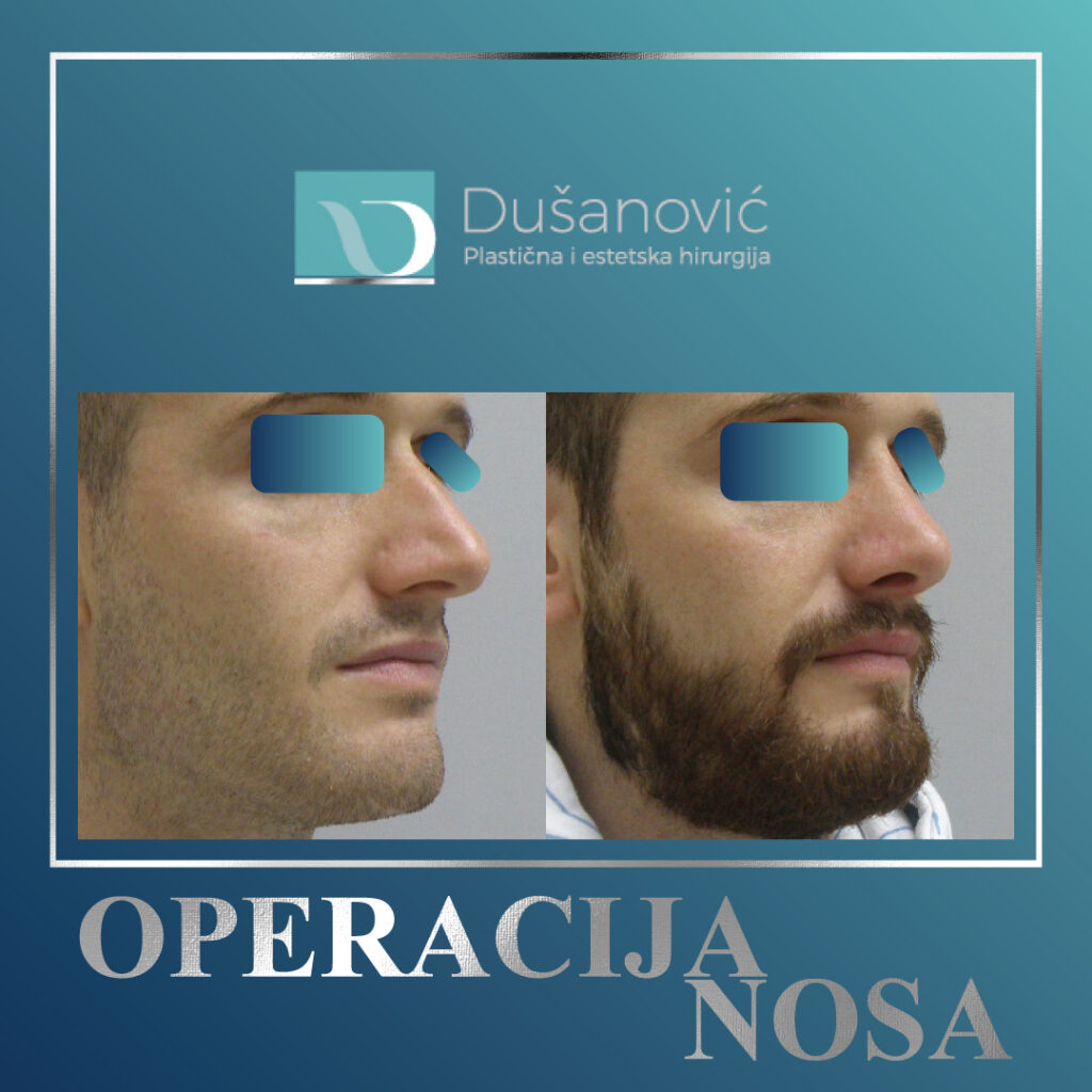 korekcija nosa