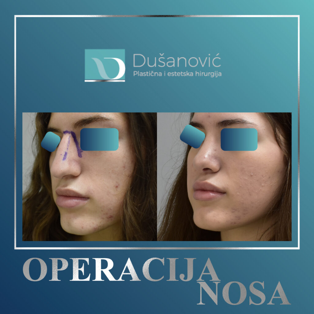 korekcija nosa