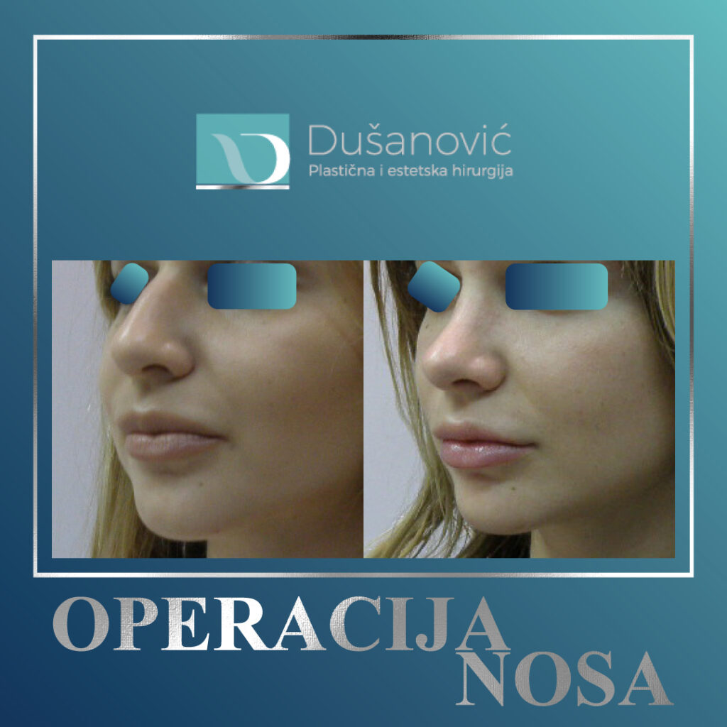 korekcija nosa