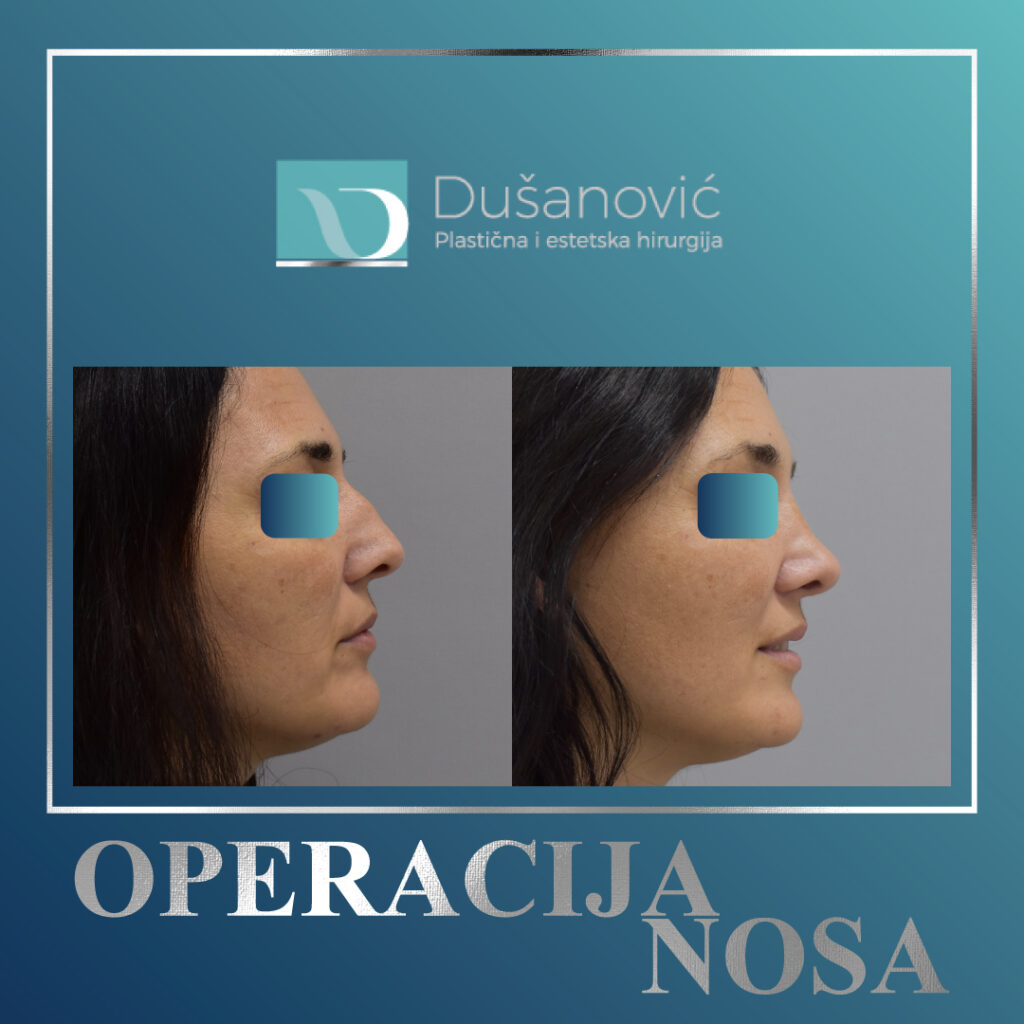 korekcija nosa