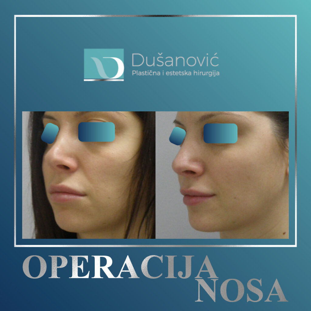 korekcija nosa