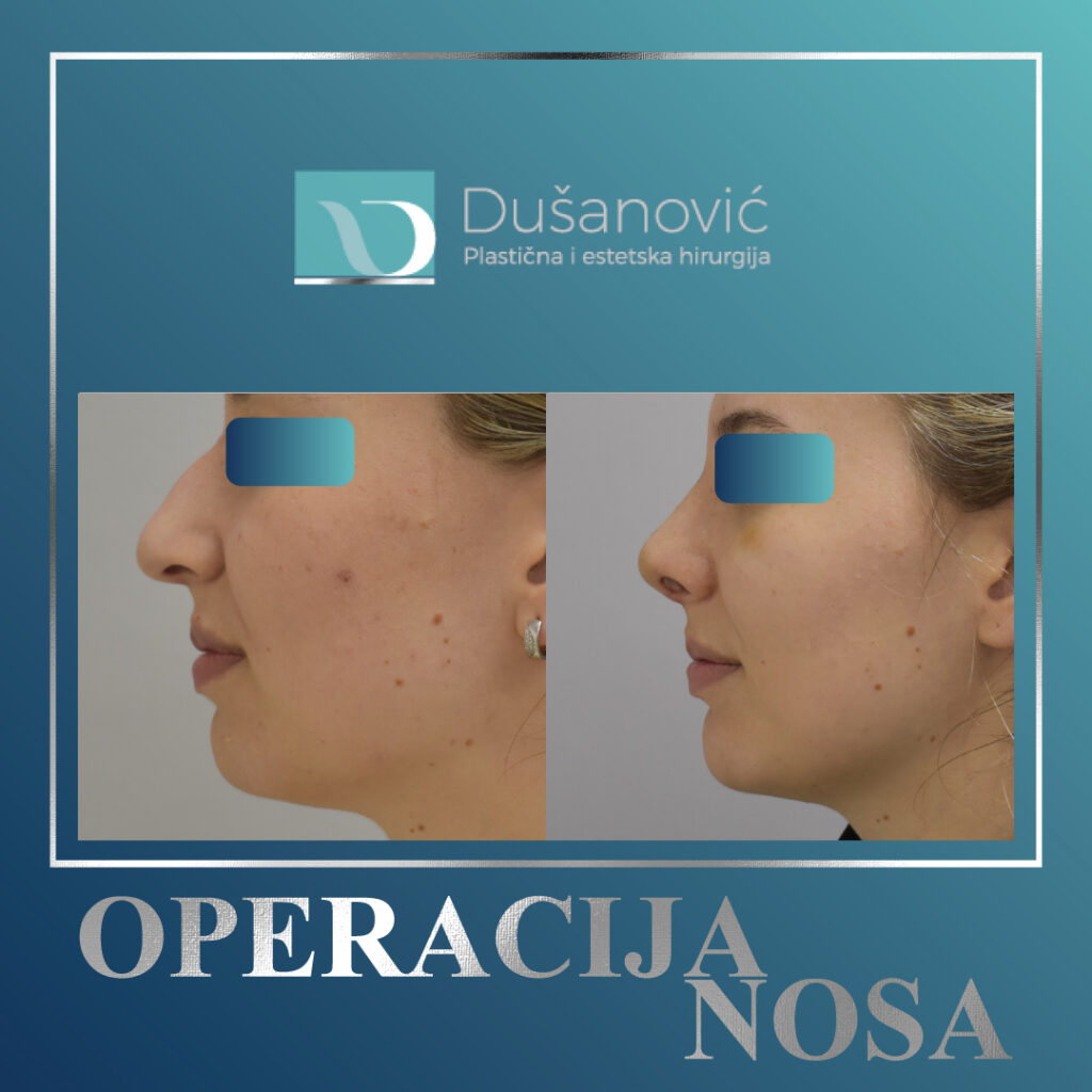 korekcija nosa