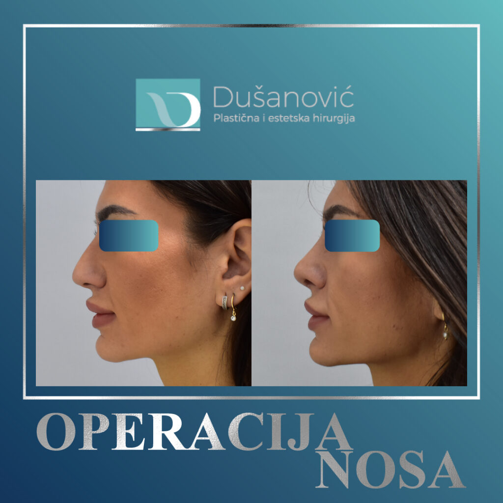korekcija nosa