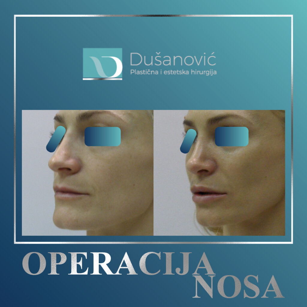 korekcija nosa