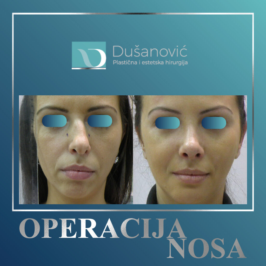 korekcija nosa