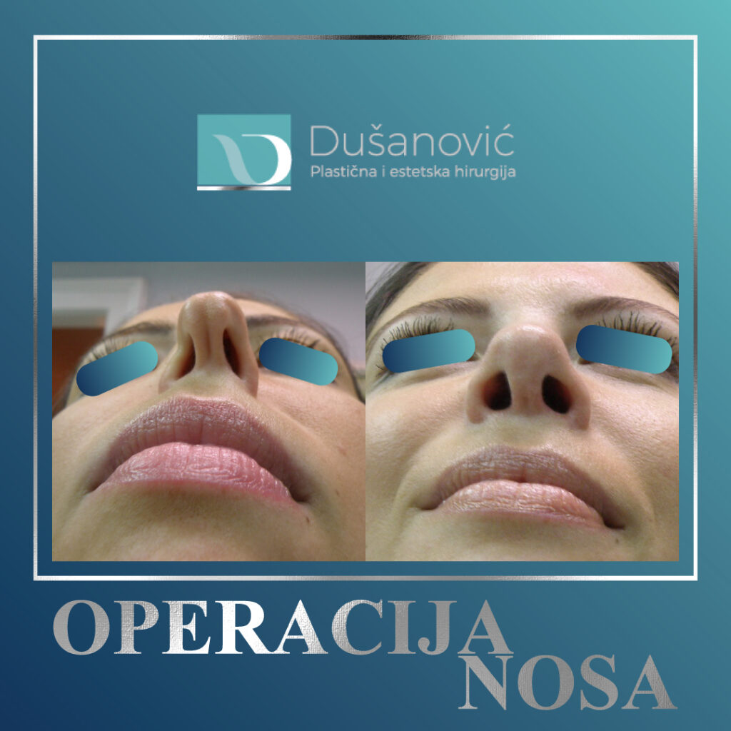 korekcija nosa