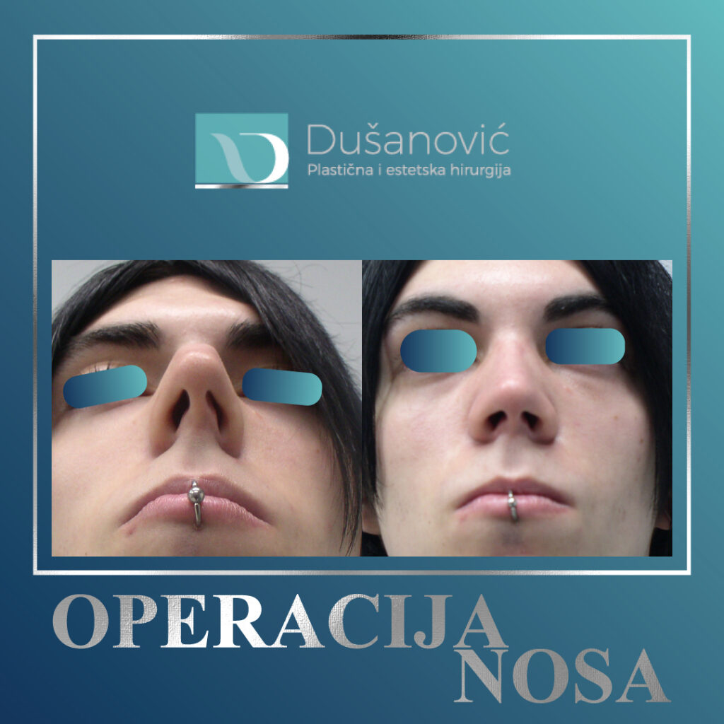 korekcija nosa
