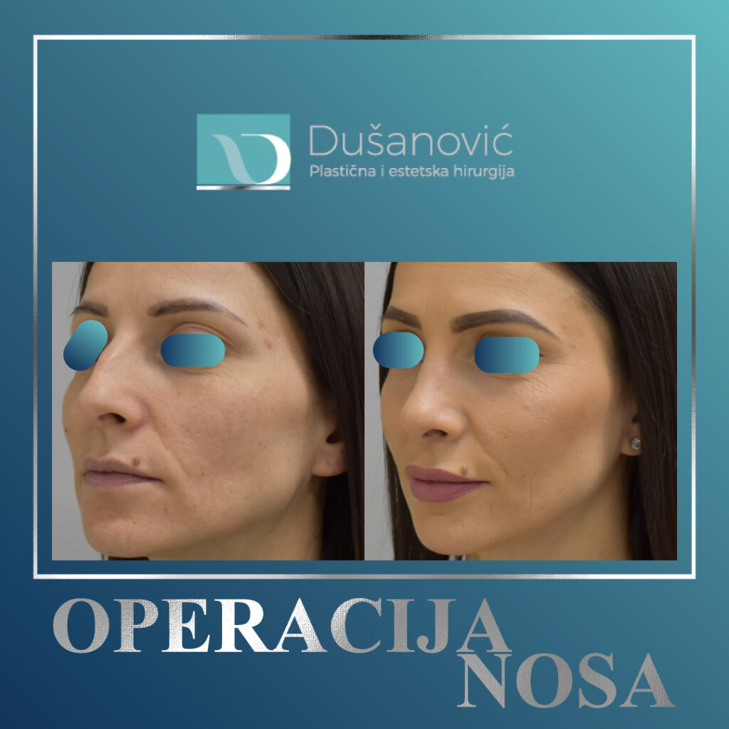 korekcija nosa