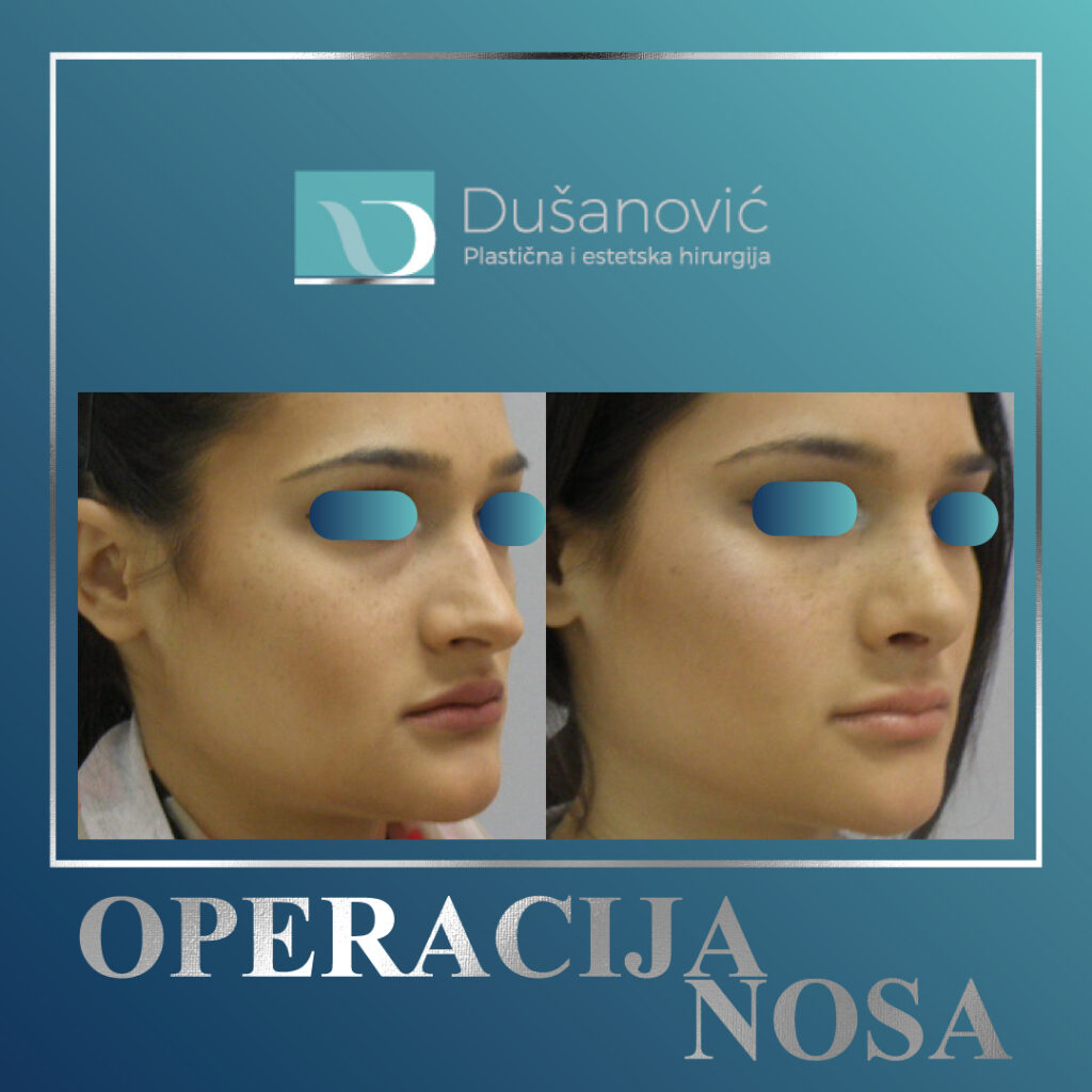 korekcija nosa