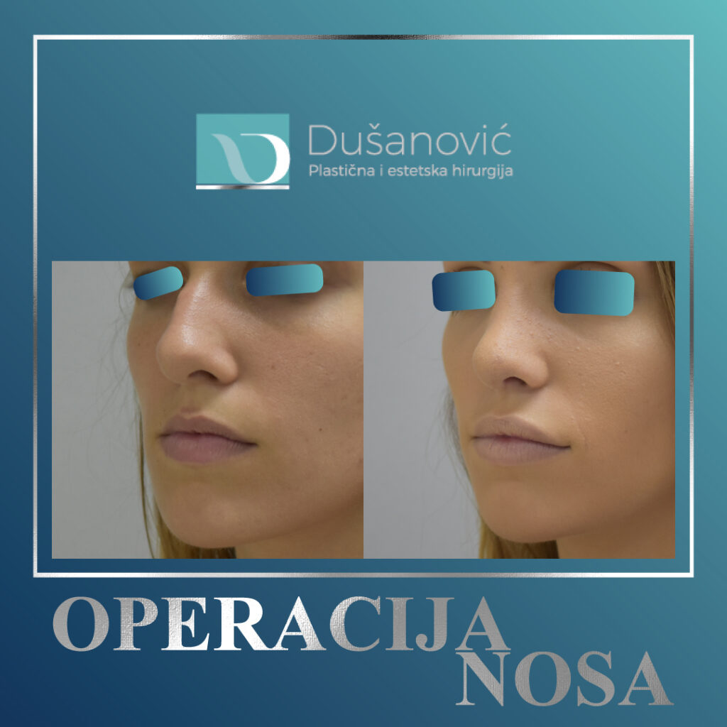 korekcija nosa