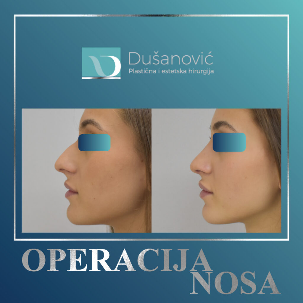 korekcija nosa