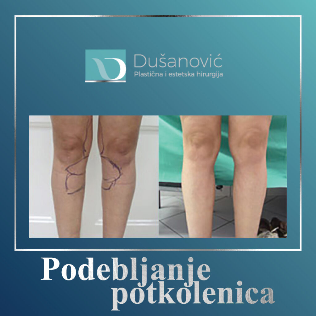 podebljanje potkolenica