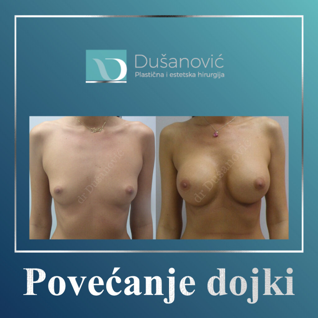 povećanje dojki