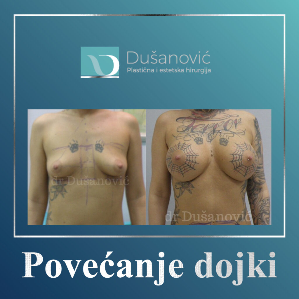povećanje dojki