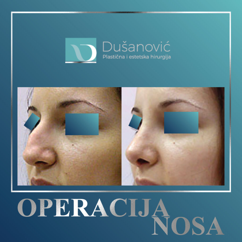 operacija nosa, sekundarna rinoplastika