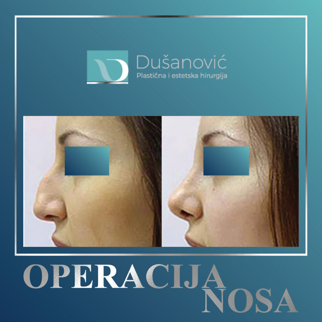 operacija nosa, sekundarna rinoplastika