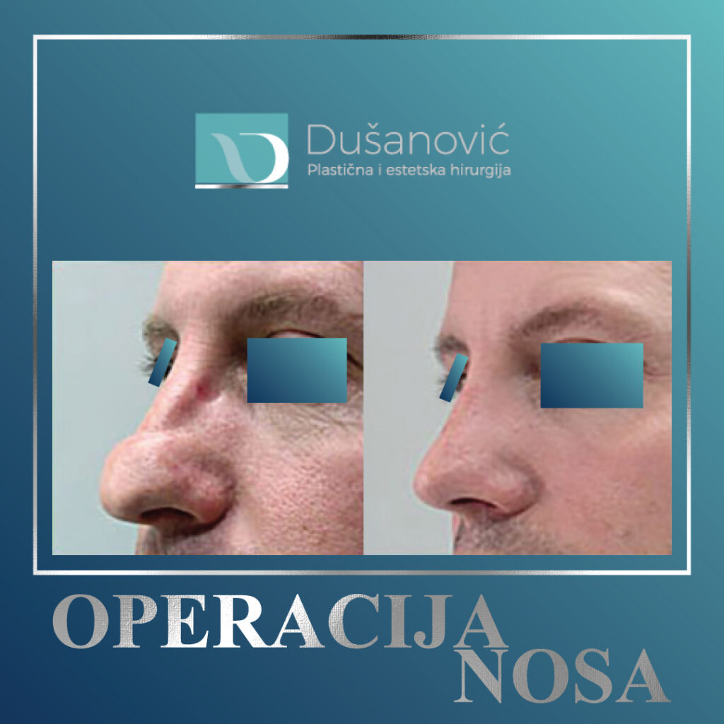 operacija nosa, sekundarna rinoplastika