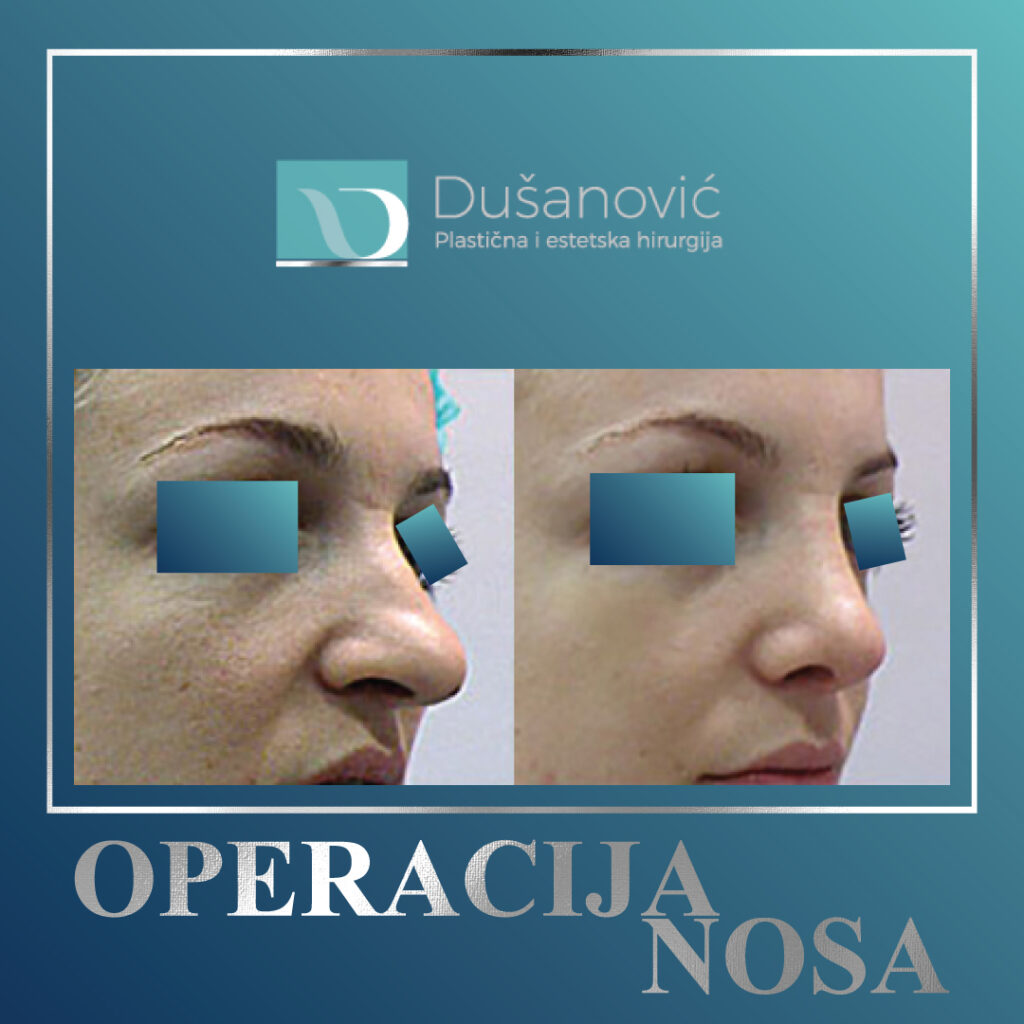 operacija nosa, sekundarna rinoplastika