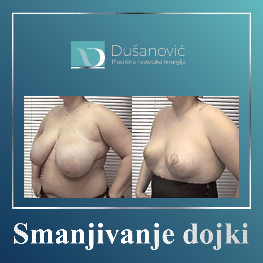 smanjivanje dojki