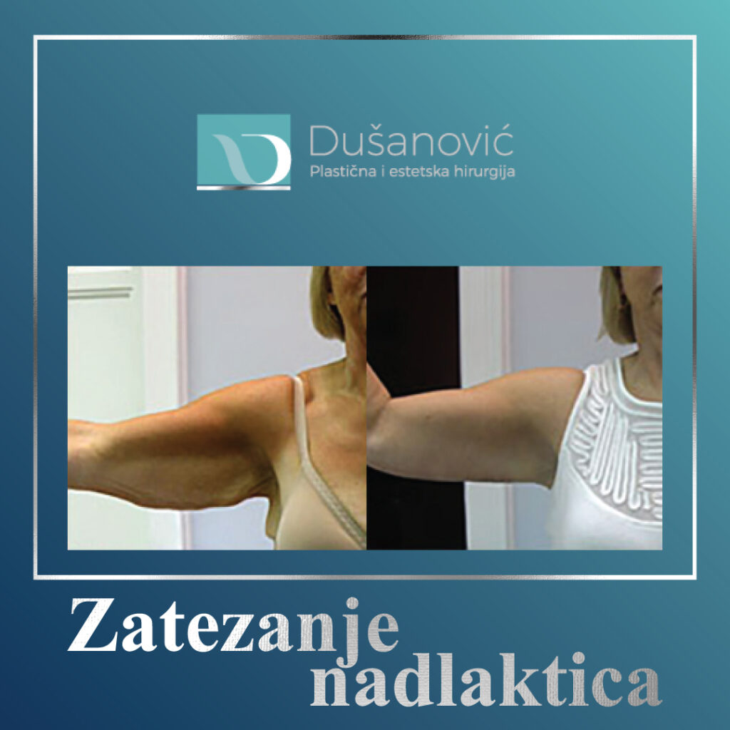 zatezanje nadlaktica
