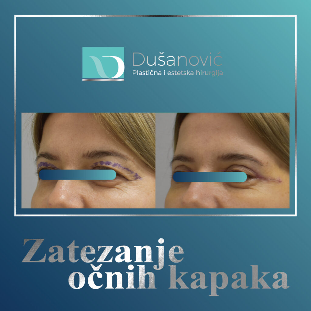 korekcija kapaka