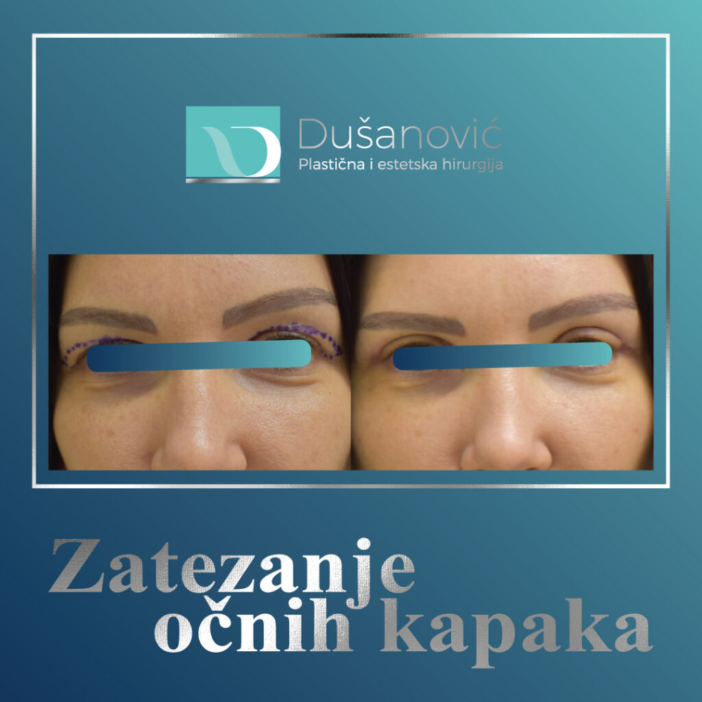 korekcija kapaka