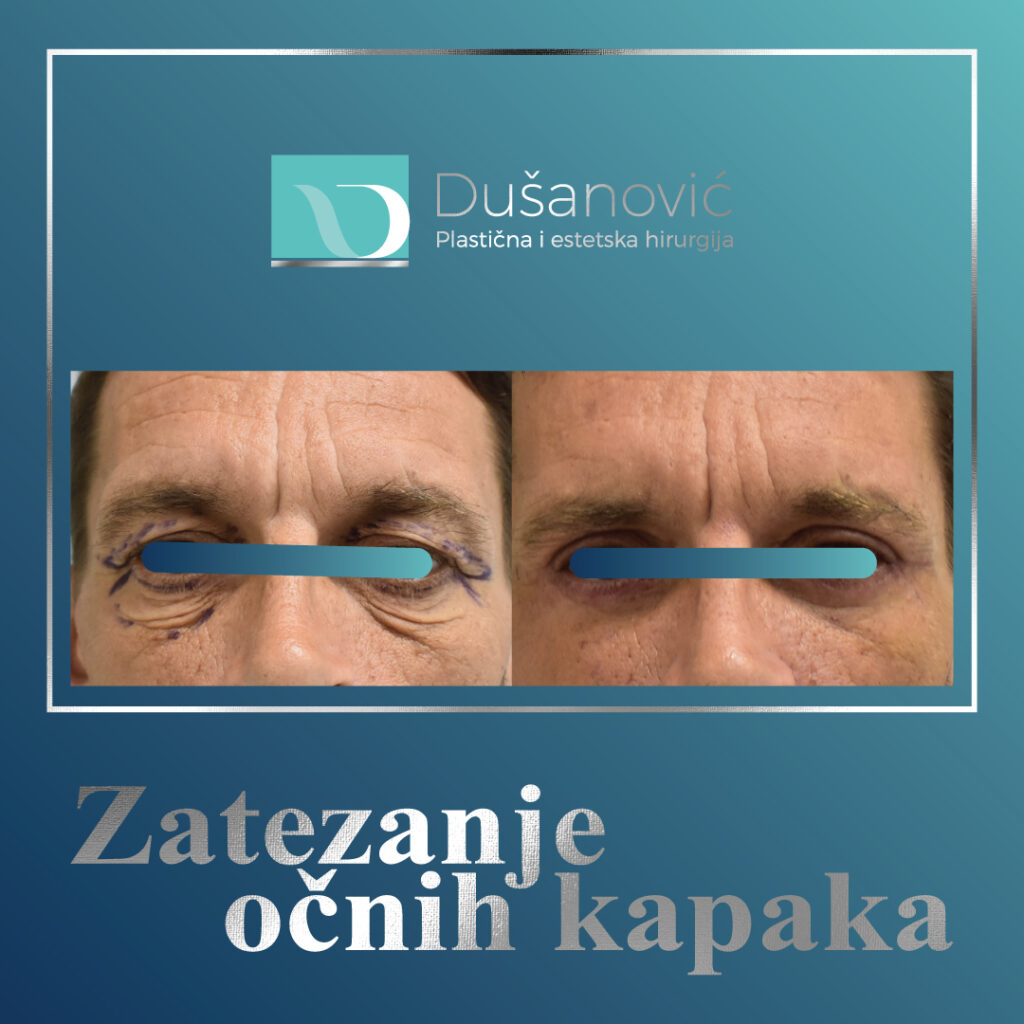 korekcija kapaka