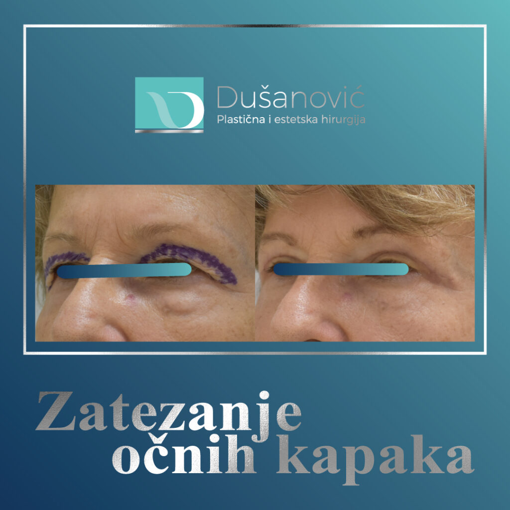 korekcija kapaka