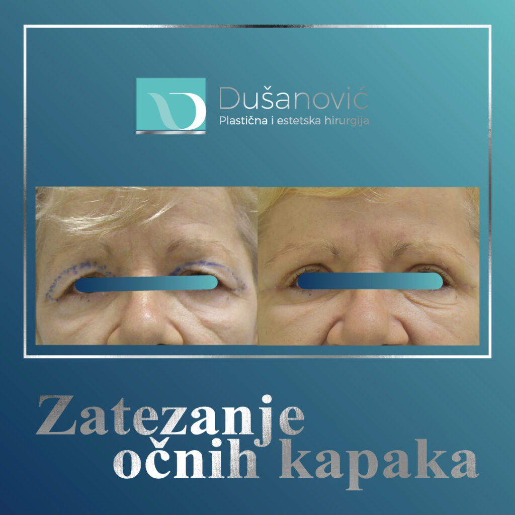 korekcija kapaka