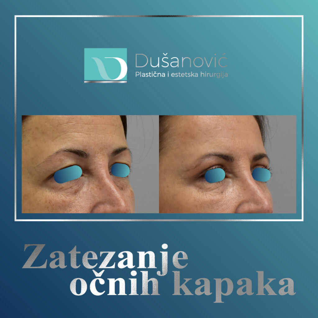 Zatezanje-očnih-kapaka-6