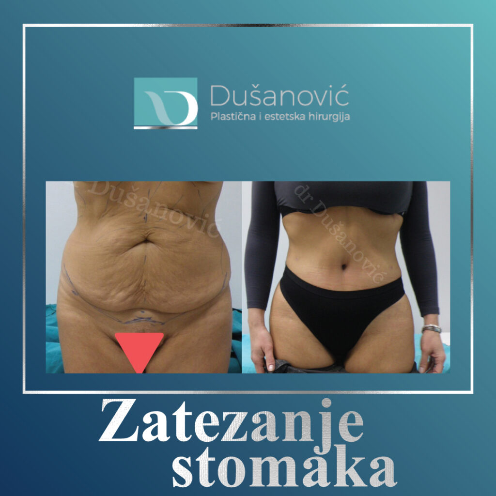 zatezanje stomaka