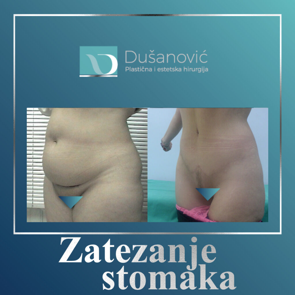 zatezanje stomaka