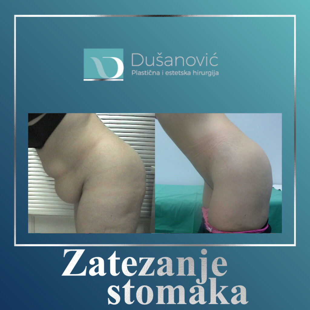 zatezanje stomaka