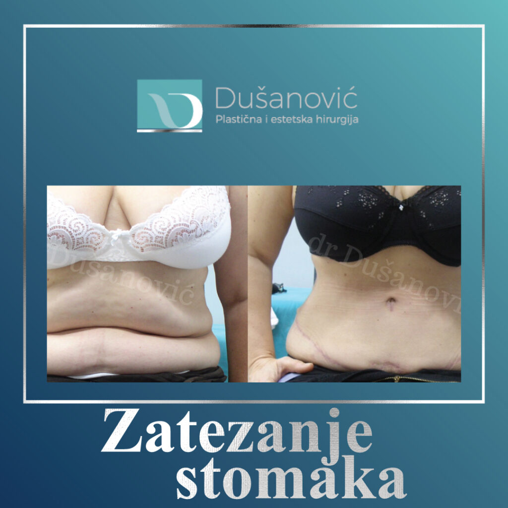 zatezanje stomaka