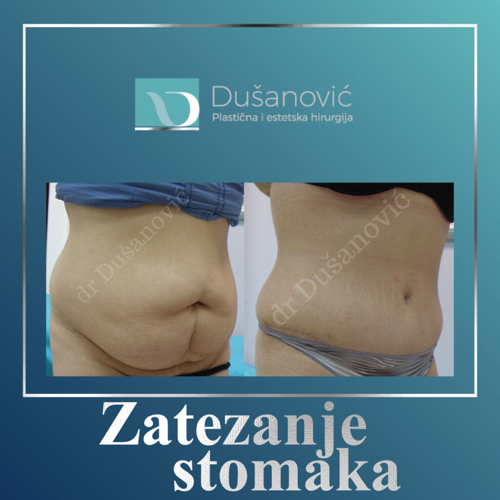 zatezanje stomaka