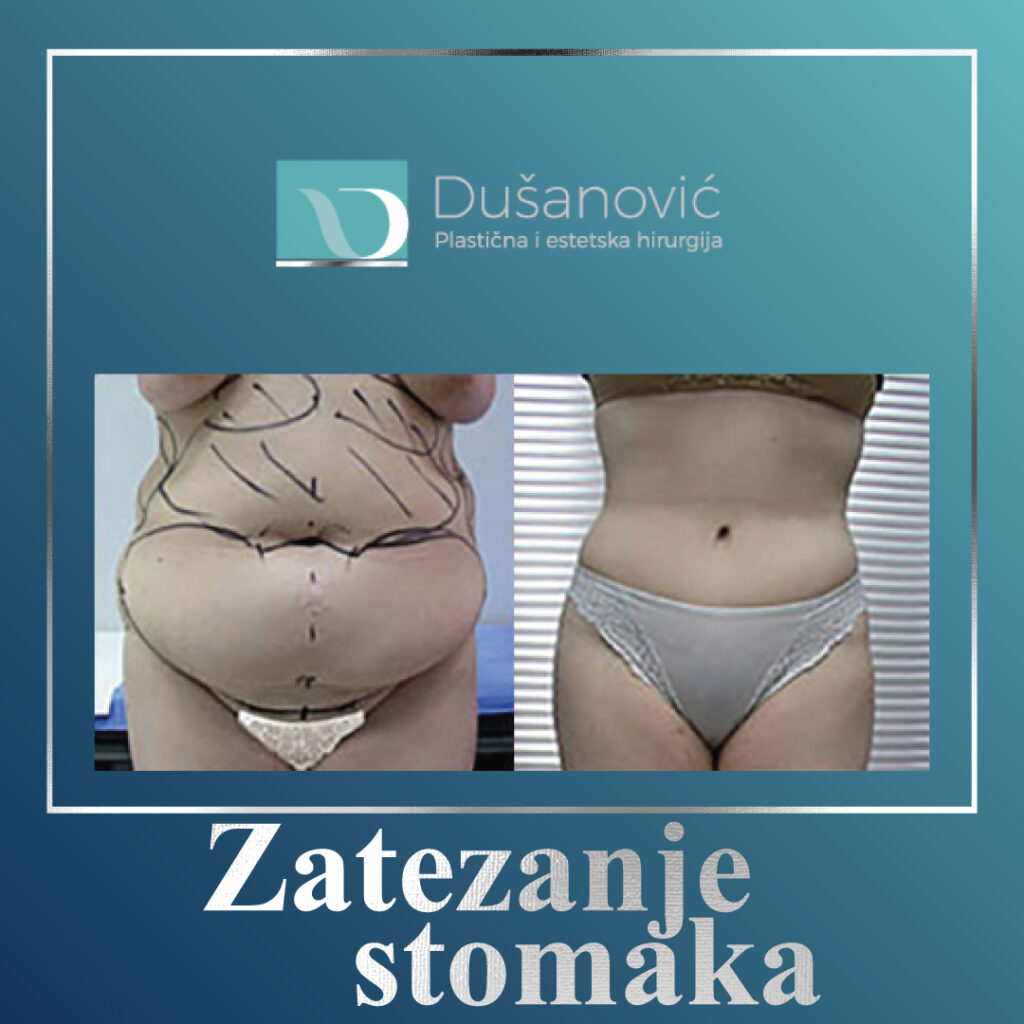 zatezanje stomaka