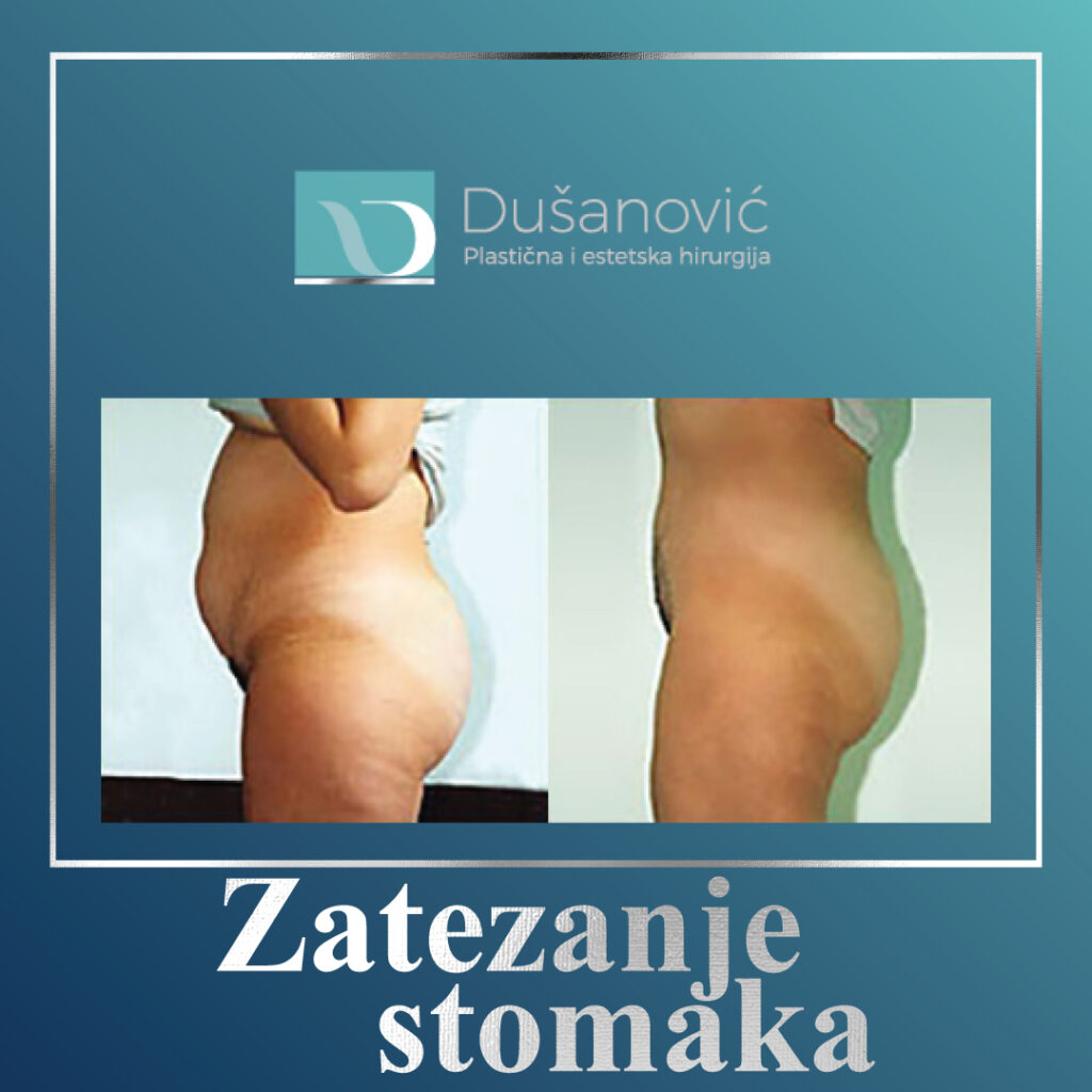 zatezanje stomaka