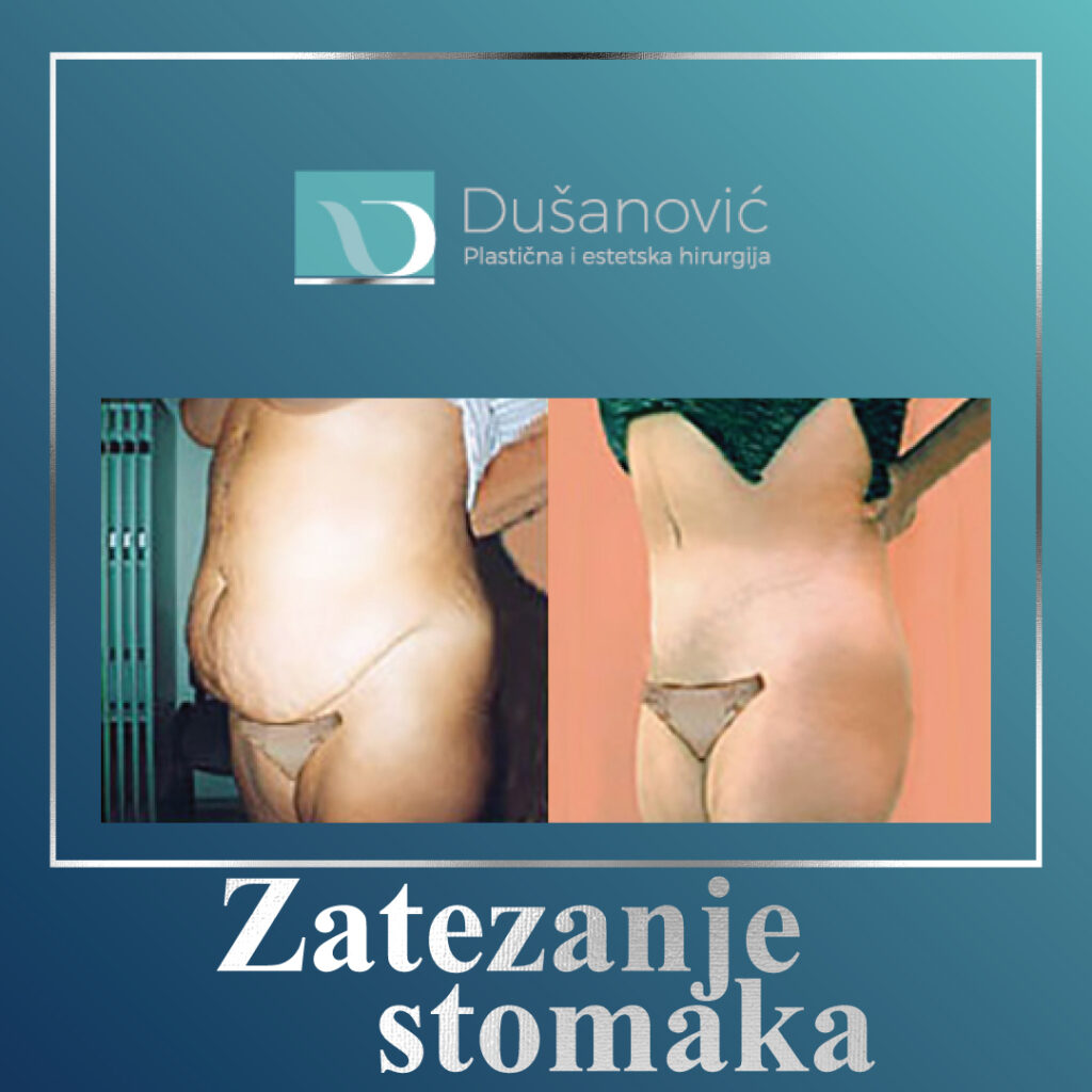 zatezanje stomaka